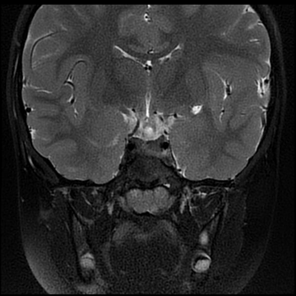 File:Adamantinomatous craniopharyngioma (Radiopaedia 77407-89529 Coronal T2 fat sat 7).jpg