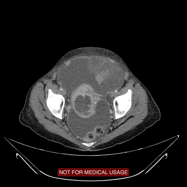 File:Adenocarcinoma of the cervix (Radiopaedia 28373-28616 Axial C+ portal venous phase 20).jpg