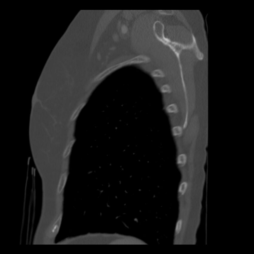 Adenocarcinoma of the lung (Radiopaedia 41015-43755 Sagittal bone window 97).jpg