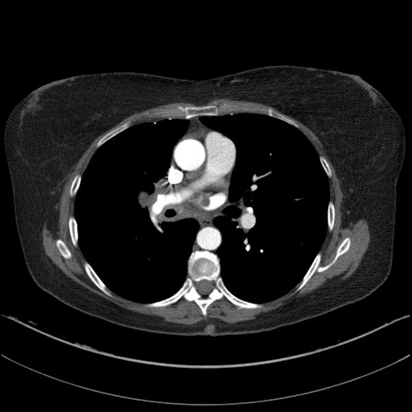 File:Adenocarcinoma of the lung (Radiopaedia 44205-47803 Axial C+ portal venous phase 42).jpg
