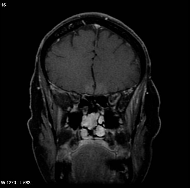 File:Adenoid cystic carcinoma (nasal septum) (Radiopaedia 4547-6668 Coronal T1 C+ fat sat 1).jpg