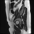 Adenomyosis - ovarian endometriomas (Radiopaedia 67031-76350 Sagittal T2 24).jpg