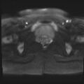 Adenomyosis and endometriotic cysts (Radiopaedia 82300-96367 Axial DWI 21).jpg