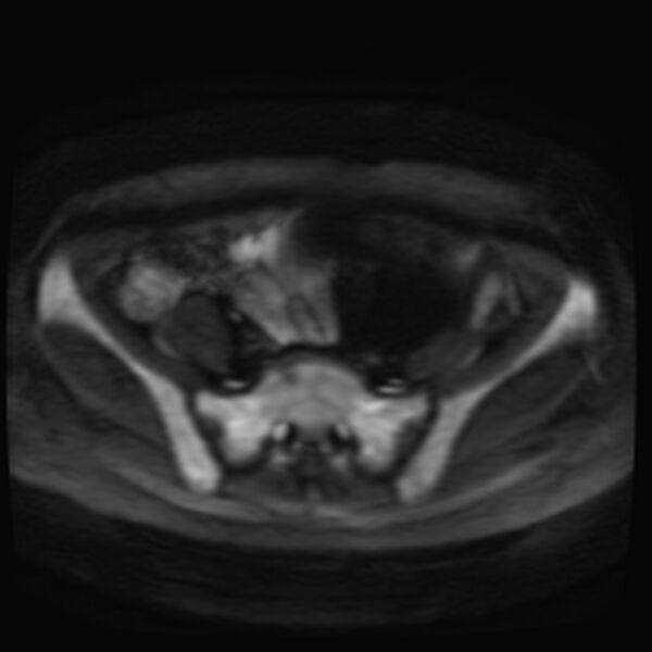 File:Adenomyosis on MRI (Radiopaedia 29328-29780 Axial DWI 2).jpg