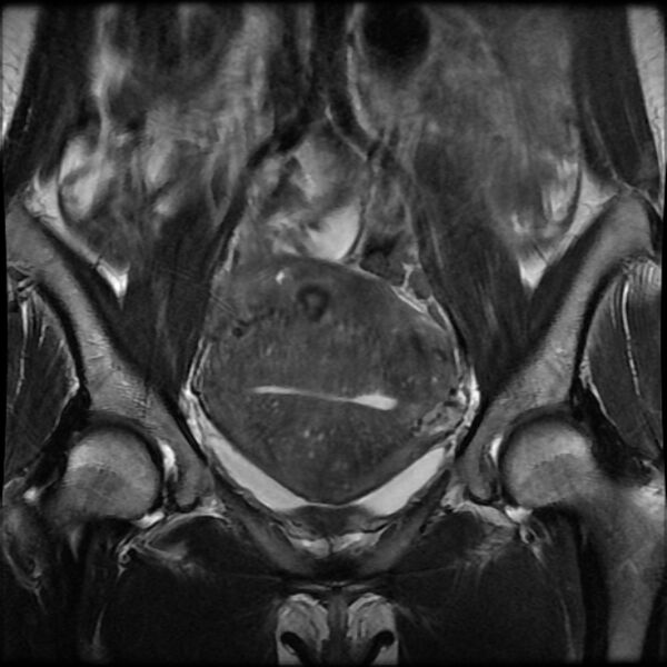 File:Adenomyosis on MRI (Radiopaedia 29328-29780 Coronal T2 10).jpg