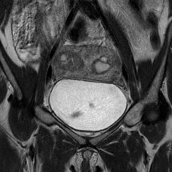 File:Adenomyosis within a septate uterus (Radiopaedia 69963-79981 Coronal T2 9).jpg