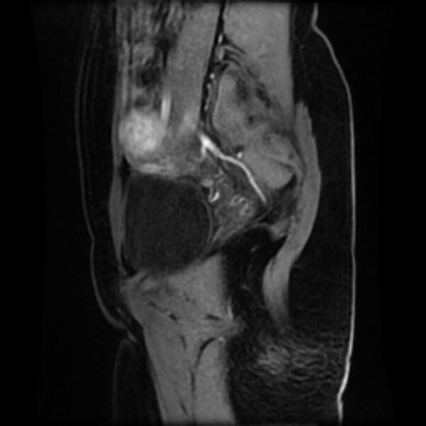 File:Adenomyosis within a septate uterus (Radiopaedia 69963-79981 Sagittal LAVA-Dyn 26).jpg