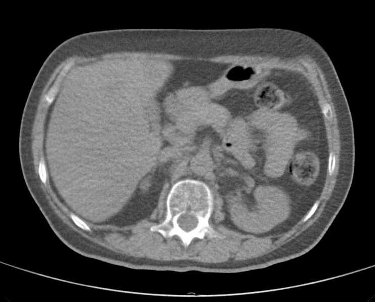 File:Adenosquamous lung carcinoma (Radiopaedia 22035-22030 non-contrast 64).jpg