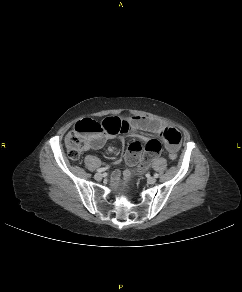 Adhesional small bowel obstruction (Radiopaedia 85402-101024 Axial C+ portal venous phase 212).jpg