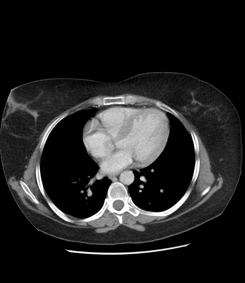 Adrenal cortical carcinoma with IVC invasion and thrombosis (Radiopaedia 34307-35597 Axial C+ portal venous phase 2).jpg