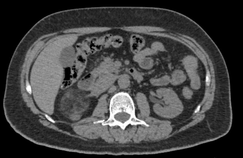 Adrenal myelolipoma (Radiopaedia 65240-74253 Axial non-contrast 57).jpg