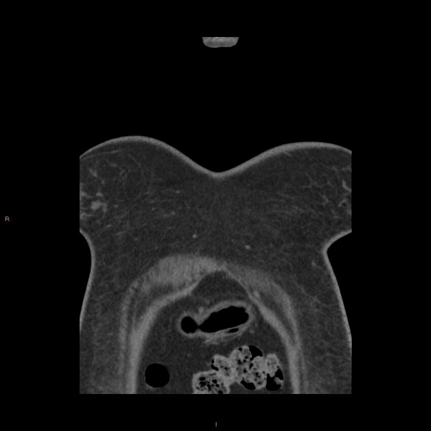 Agenesis of the left hepatic lobe (Radiopaedia 77284-89359 Coronal C+ CTPA 79).jpg