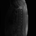 Aggressive vertebral hemangioma (Radiopaedia 39937-42404 B 10).png