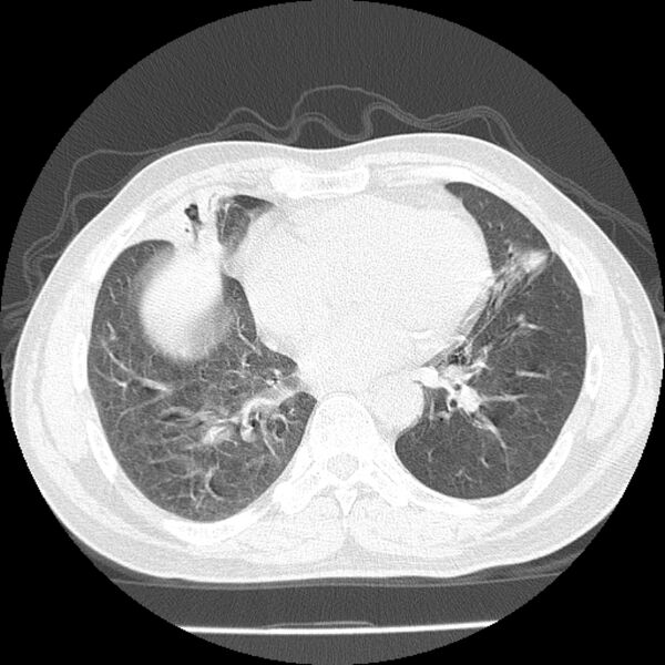 File:Airway foreign body in adult (Radiopaedia 85907-101779 Axial lung window 121).jpg
