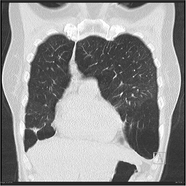 File:Alpha-1-antitrypsin deficiency (Radiopaedia 26537-26678 Coronal lung window 6).jpg