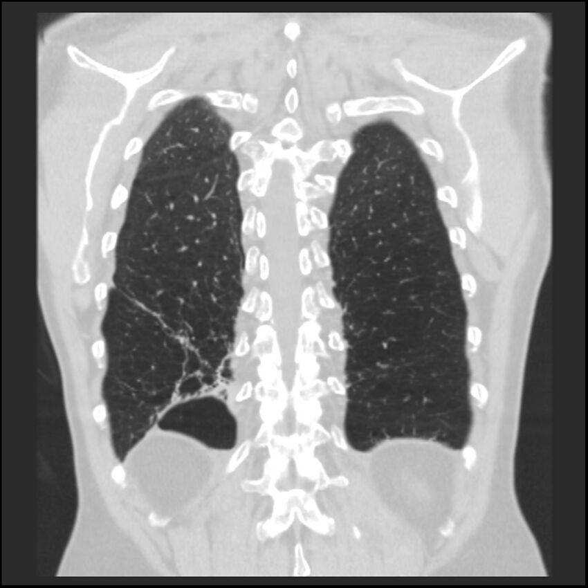 Alpha-1-antitrypsin deficiency (Radiopaedia 40993-43722 Coronal lung window 88).jpg