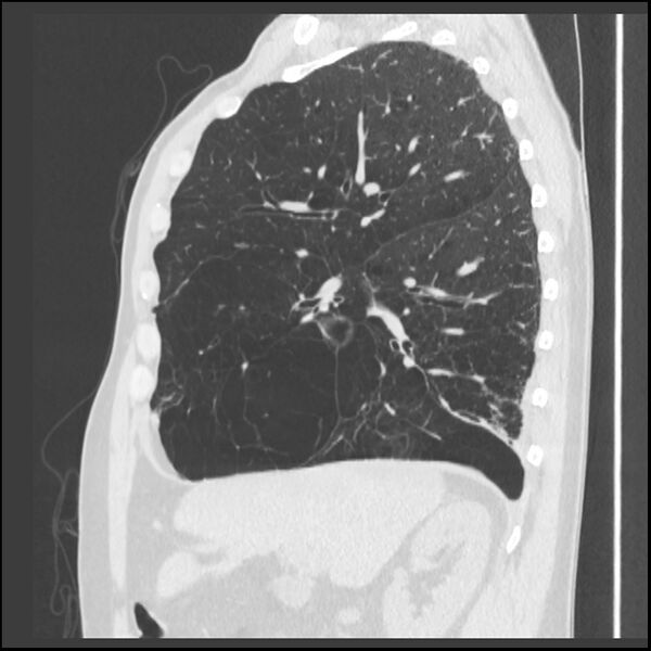 File:Alpha-1-antitrypsin deficiency (Radiopaedia 40993-43722 Sagittal lung window 180).jpg