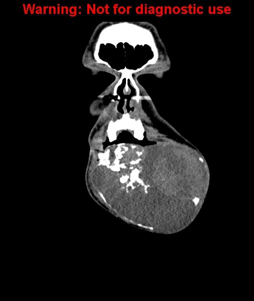 File:Ameloblastoma (Radiopaedia 33126-34164 D 13).jpg