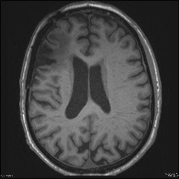 File:Anaplastic meningioma with recurrence (Radiopaedia 34452-35788 Axial T1 86).jpg