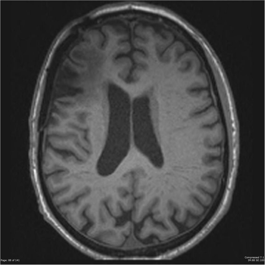 Anaplastic meningioma with recurrence (Radiopaedia 34452-35788 Axial T1 86).jpg