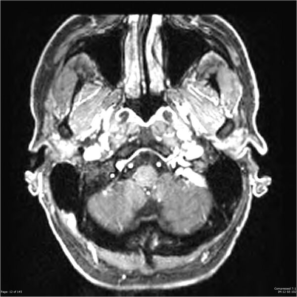 File:Anaplastic meningioma with recurrence (Radiopaedia 34452-35788 Axial T1 C+ 12).jpg