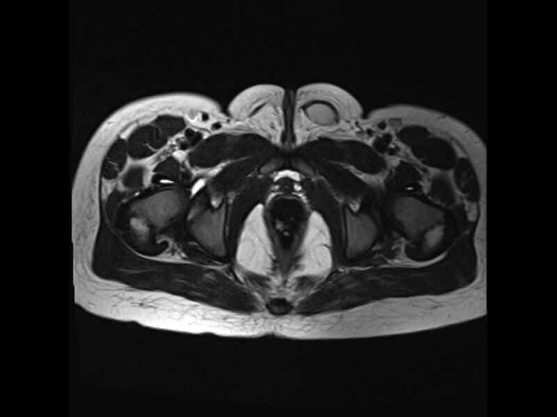 File:Androgen insensitivity syndrome (Radiopaedia 42046-45081 Axial T2 32).jpg