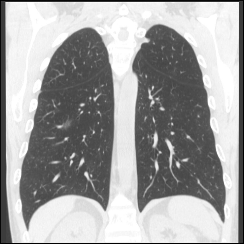 Angioinvasive aspergillosis (Radiopaedia 43957-47466 Coronal lung window 29).jpg