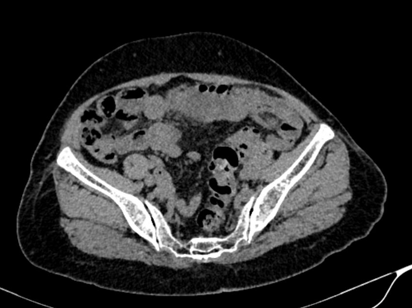 Angiomyolipoma (Radiopaedia 83682-98824 Axial non-contrast 50).jpg