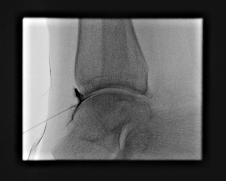 File:Ankle joint injection (fluoroscopic guided) (Radiopaedia 87288-103578 Lateral 16).jpg