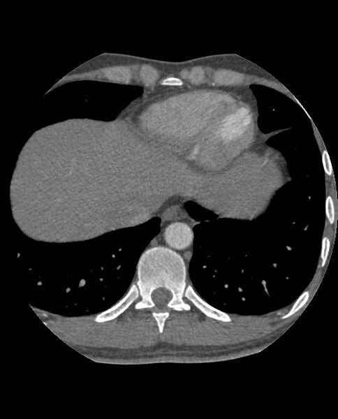 File:Anomalous coronary arteries (Radiopaedia 83979-99206 A 272).jpg