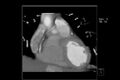 Anomalous right coronary artery (ARCA) with interarterial course (Radiopaedia 12423-12677 C 6).jpg