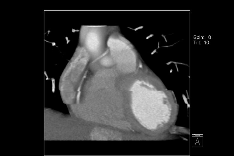 File:Anomalous right coronary artery (ARCA) with interarterial course (Radiopaedia 12423-12677 C 6).jpg