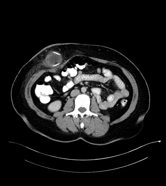 File:Anterior abdominal wall CSF pseudocyst (CSFoma) (Radiopaedia 79453-92571 A 49).jpg