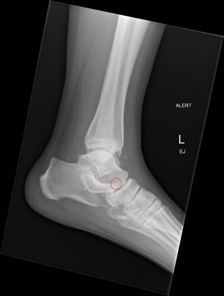 File:Anterior calcaneal process fracture (Radiopaedia 50110-55422 A 1).jpg