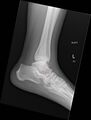 Anterior calcaneal process fracture (Radiopaedia 50110-55422 A 1).jpg