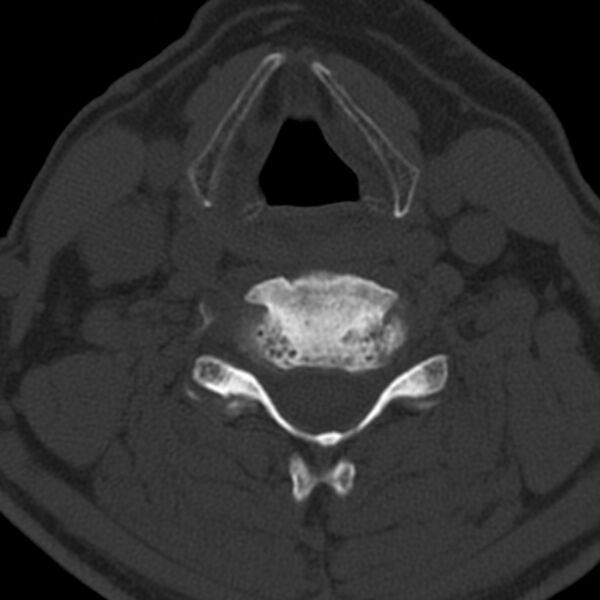 File:Anterior cervical postdiscectomy arthrodesis (Radiopaedia 32678-33646 Axial bone window 46).jpg