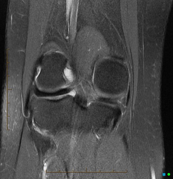File:Anterior cruciate ligament ganglion cyst (Radiopaedia 3582-6491 Coronal PD fat sat 6).jpg