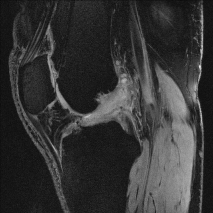 Anterior cruciate ligament mucoid degeneration (Radiopaedia 68400-77933 Sagittal 32).jpg