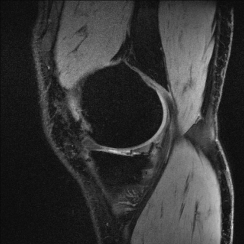 Anterior cruciate ligament mucoid degeneration (Radiopaedia 68400-77933 Sagittal 54).jpg