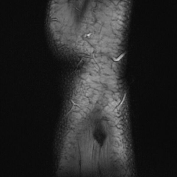 File:Anterior cruciate ligament tear - ramp lesion (Radiopaedia 71883-82322 Sagittal T2 fat sat 1).jpg