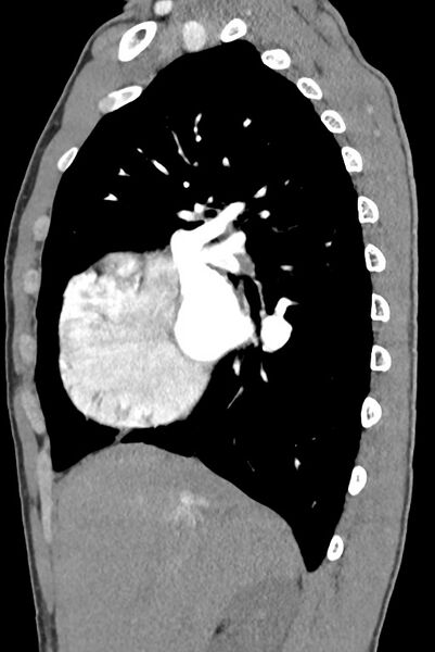 File:Aortic coarctation with aneurysm (Radiopaedia 74818-85828 B 57).jpg