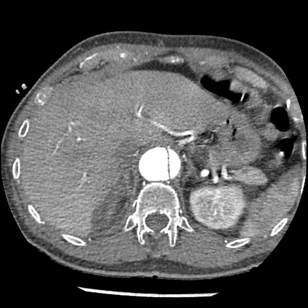 File:Aortic dissection - DeBakey Type I-Stanford A (Radiopaedia 79863-93115 A 38).jpg