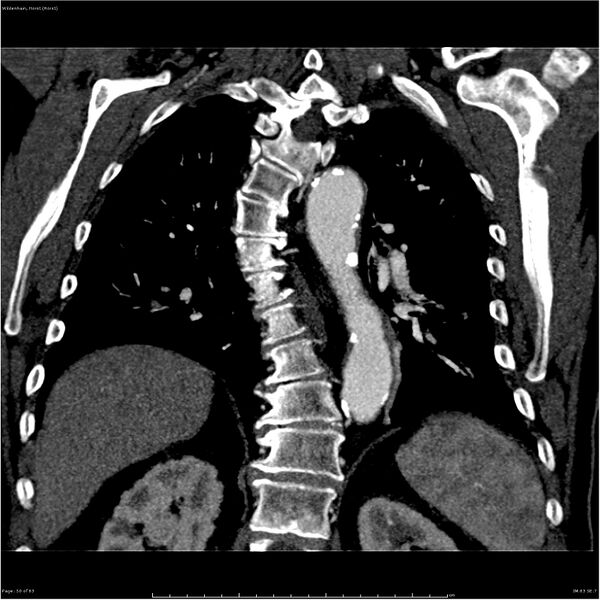 File:Aortic dissection - Stanford type A (Radiopaedia 26183-26315 A 50).jpg