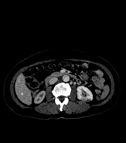 File:Aortic dissection with renal ischemia (Radiopaedia 76573-88338 B 40).jpg