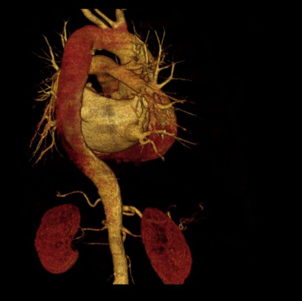 File:Aortic dissection with rupture into pericardium (Radiopaedia 12384-12647 D 17).jpg