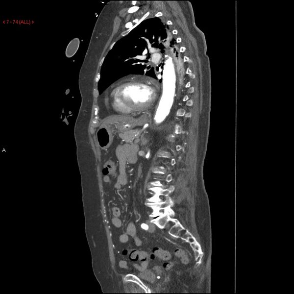 File:Aortic intramural hematoma (Radiopaedia 27746-28001 C 43).jpg
