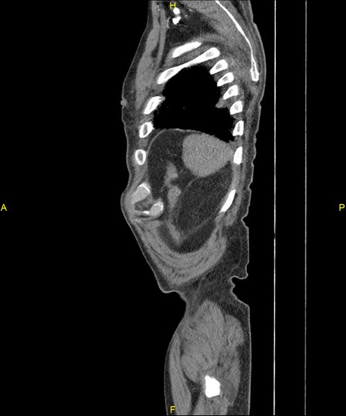 File:Aortoenteric fistula (Radiopaedia 84308-99603 C 308).jpg