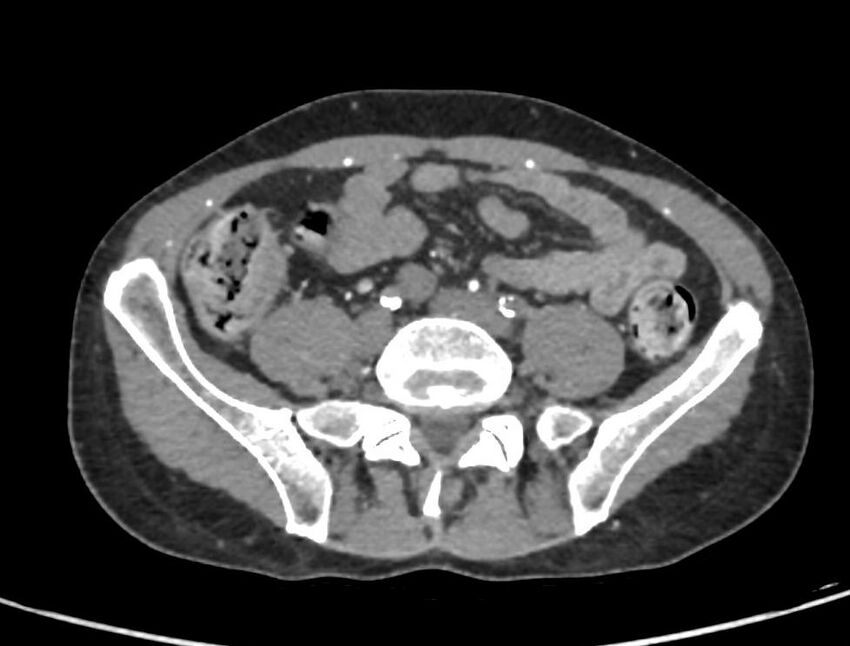 Aortoiliac occlusive disease (Radiopaedia 89182-106053 A 43).jpg