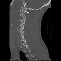 Apical pneumothorax on cervical spine CT (Radiopaedia 45343-49368 Sagittal bone window 7).jpg