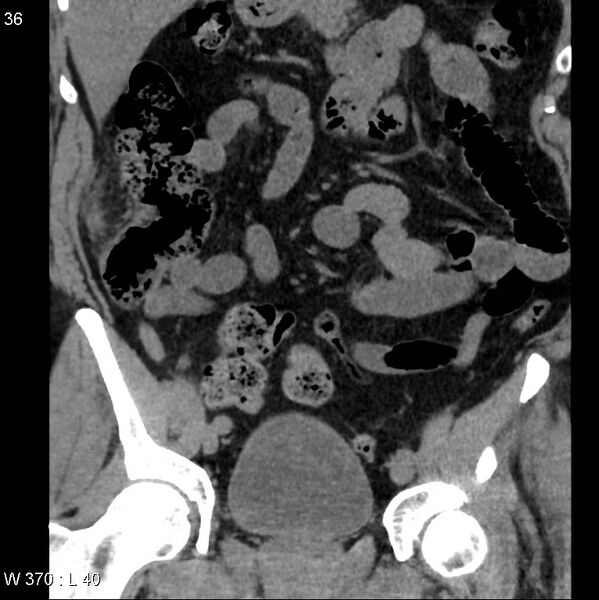 File:Appendicitis (Radiopaedia 12510-12733 Coronal non-contrast 6).jpg